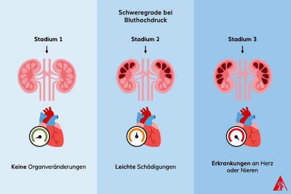 Schweregrade von Bluthochdruck Eine Illustration der Schweregrade bei Bluthochdruck. Erst im zweiten Stadium sind leichte Organveränderungen wahrnehmbar und im dritten Stadium treten bereits Erkrankungen am Herz oder den Nieren auf.