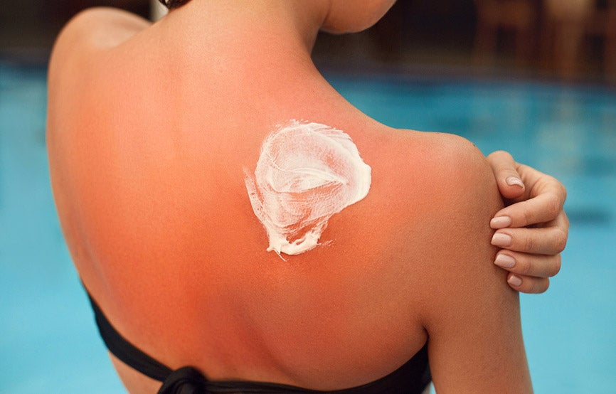 Sonnenbrand Hausmittel: Die besten Tipps bei Sonnenbrand