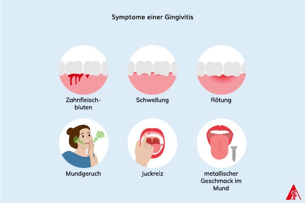 Symptome einer Zahnfleischentzündung Eine Illustration von Symptomen einer Gingivitis. Dazu gehören Zahnfleischbluten, Schwellungen, Rötungen, Mundgeruch, Juckreiz sowie ein metallischer Geschmack im Mund.