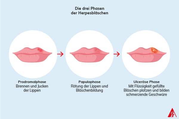 Die drei Phasen der Herpesbläschen (Prodromalphase, Papulaphase und Ulceröse Phase) Eine Illustration der drei Phasen der Herpesbläschen. In der Prodromalphase verspürt man ein Brennen und Jucken der Lippen. In der Papulaphase röten sich die Lippen und es kommt zur Bildung von Bläschen. In der Ulcerösen Phase füllen sich diese mit Flüssigkeit und platzen, was zur Bildung von schmerzenden Geschwüren führt.