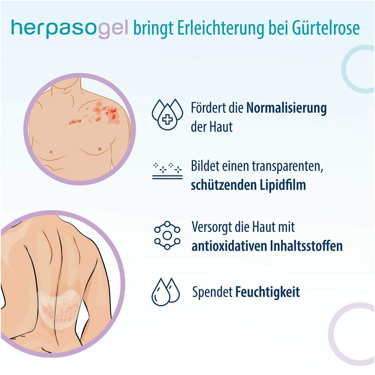 Herpasogel bei Gürtelrose 50 ml