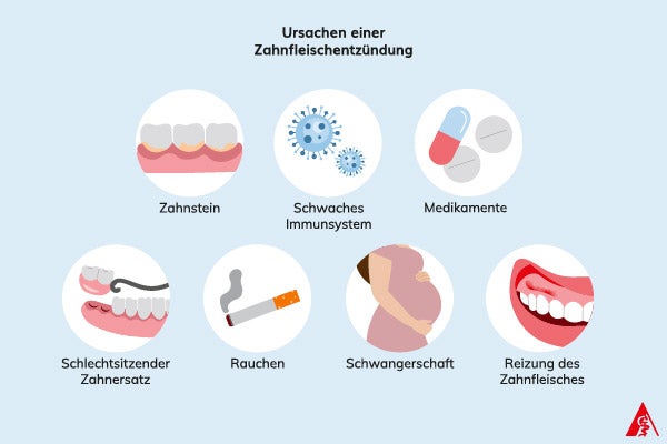 Ursachen einer Zahnfleischentzündung Eine Illustration der Ursachen einer Zahnfleischentzündung. Dazu gehören Zahnstein, ein schwaches Immunsystem, bestimmte Medikamente, schlechtsitzender Zahnersatz, Rauchen, Schwangerschaft sowie Reizung des Zahnfleisches.