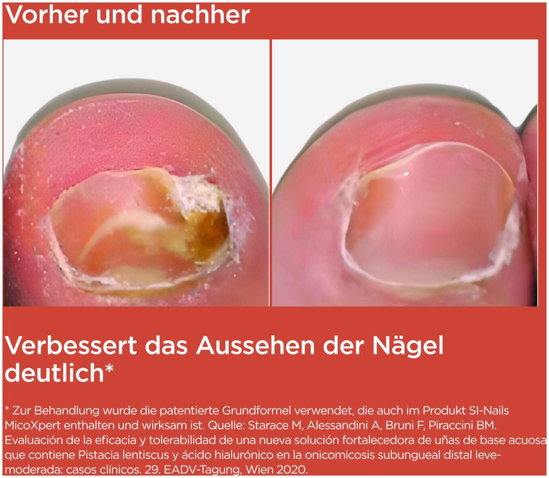 Isdin Si-Nails  Micoxpert Md Stift 4,5 ml