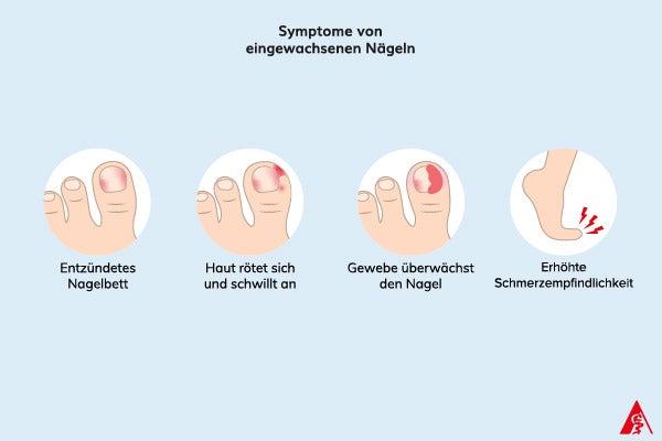 Symptome von eingewachsenen Nägeln Eine Illustration der Symptome von eingewachsenen Nägeln. Dazu gehören eine erhöhte Schmerzempfindlichkeit an der betroffenen Stelle, ein entzündetes Nagelbett, gerötete und geschwollene Haut sowie die Bildung von Granulationsgewebe in einem späteren Stadium.