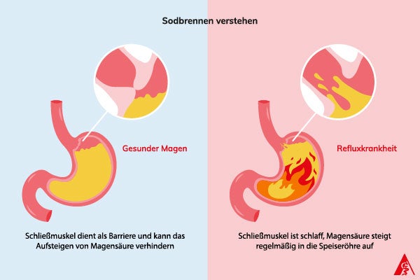 Sodbrennen verstehen Bei einem gesunden Magen fungiert der Schließmuskel wie eine Art Barriere zur Speiseröhre. Bei der Refluxkrankheit hingegen lässt ist der Schließmuskel bereits schlaff und lässt Magensäure so einfacher aufsteigen.