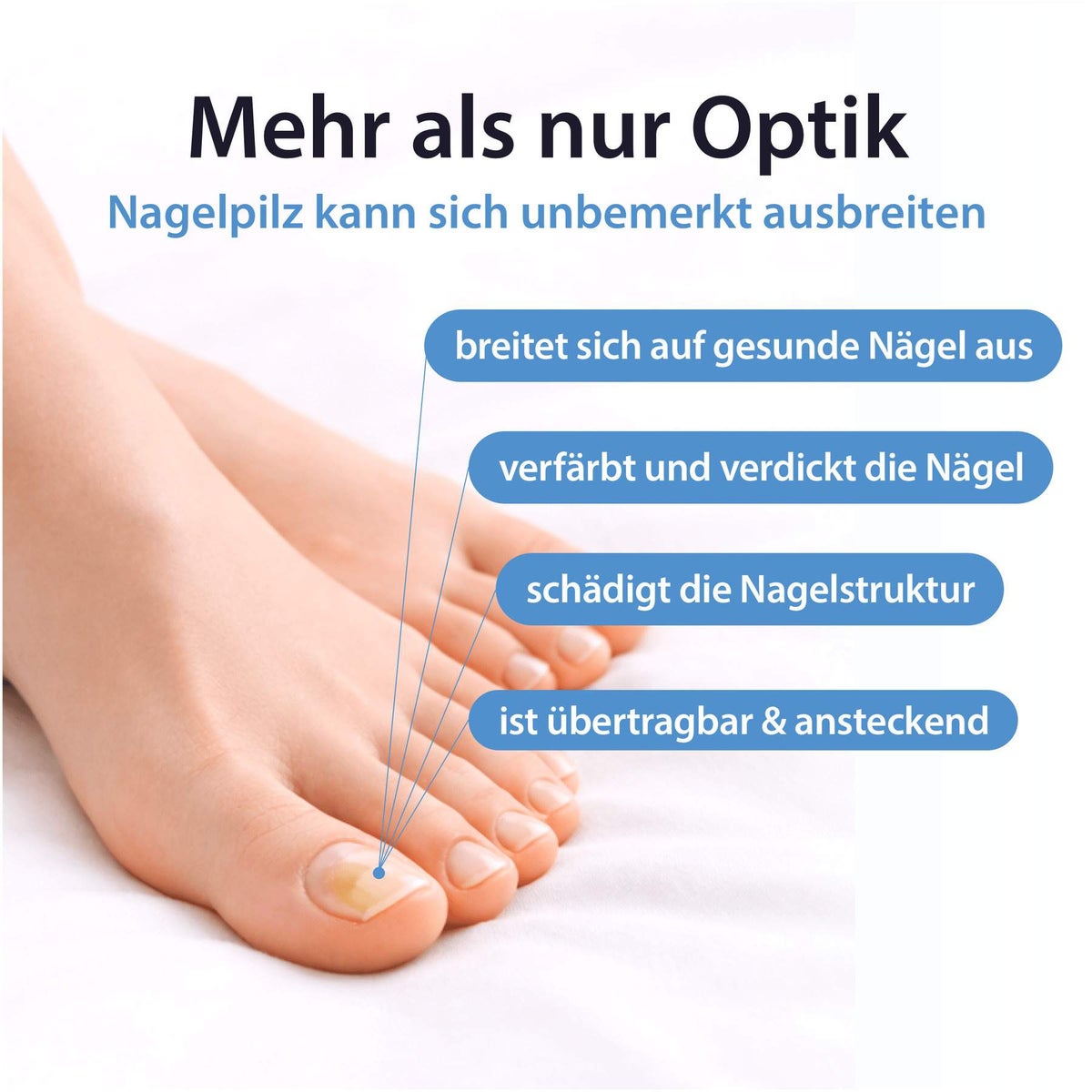 Acetocaustin Nagelpilz Stift 4 ml