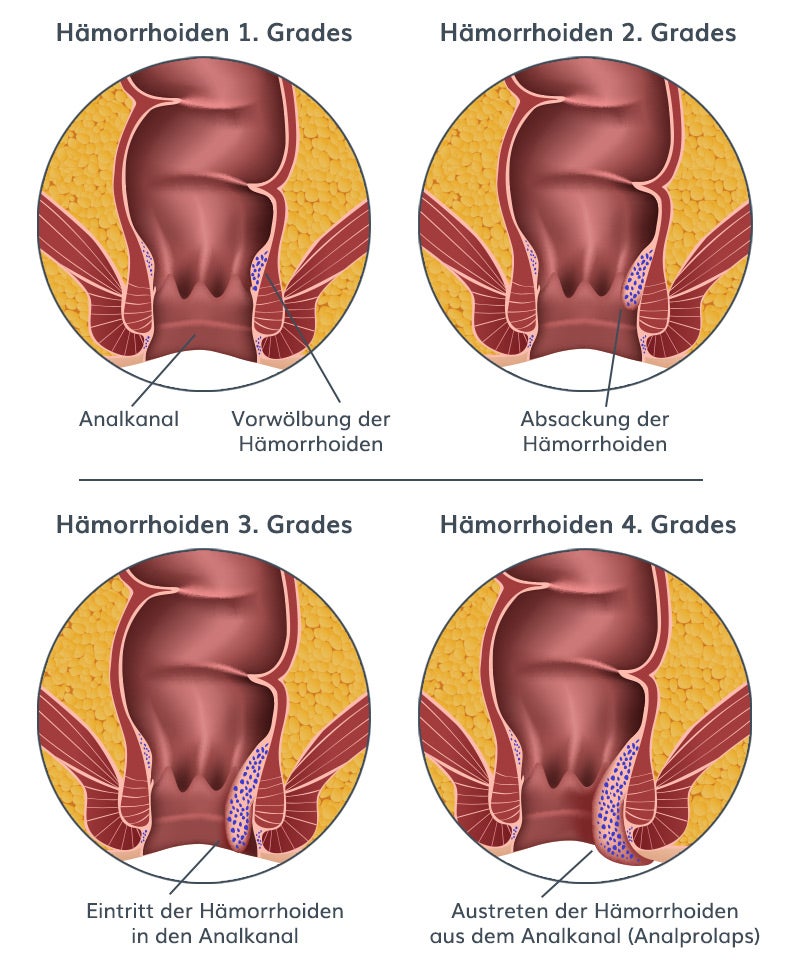 Unterscheidliche Schweregrade bei Hämorrhoidenleiden
