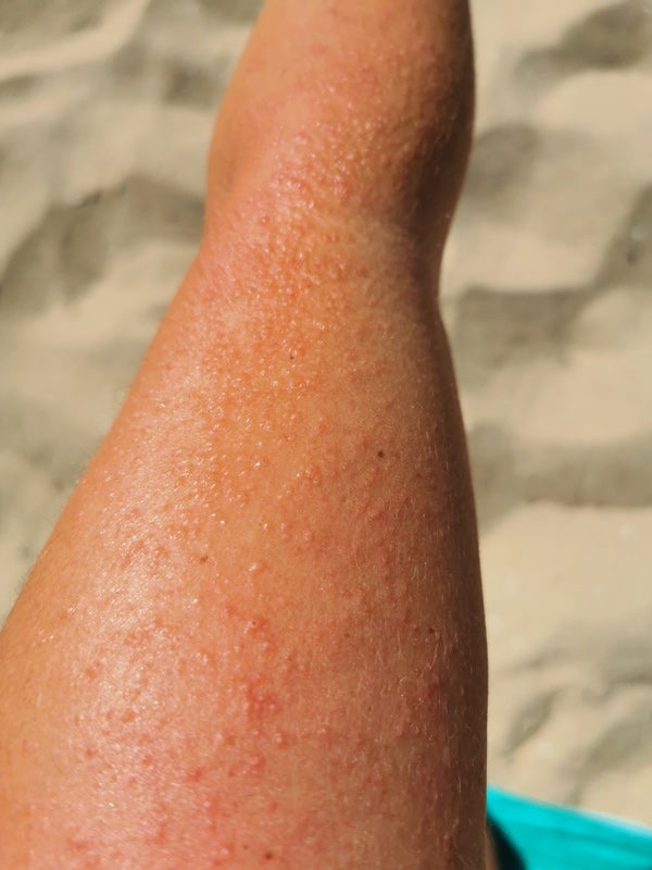 Allergische Reaktion der Haut auf Sonne Arm zeigt Sonnenallergie am Arm