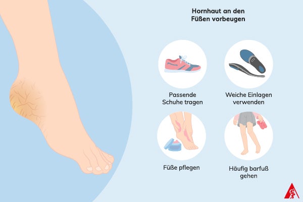 Hornhaut an den Füßen vorbeugen Die Illustration zeigt Methoden zur Vorbeugung von Hornhaut an den Füßen. Zu sehen sind passende Schuhe, weiche Einlagen, Pflegeprodukte für die Füße und eine Person, die barfuß geht.