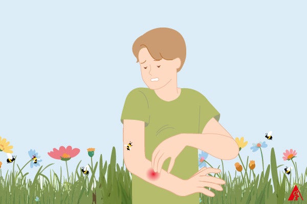 Bienenallergie – Symptome, erste Hilfe und Diagnose bei allergischer Reaktion