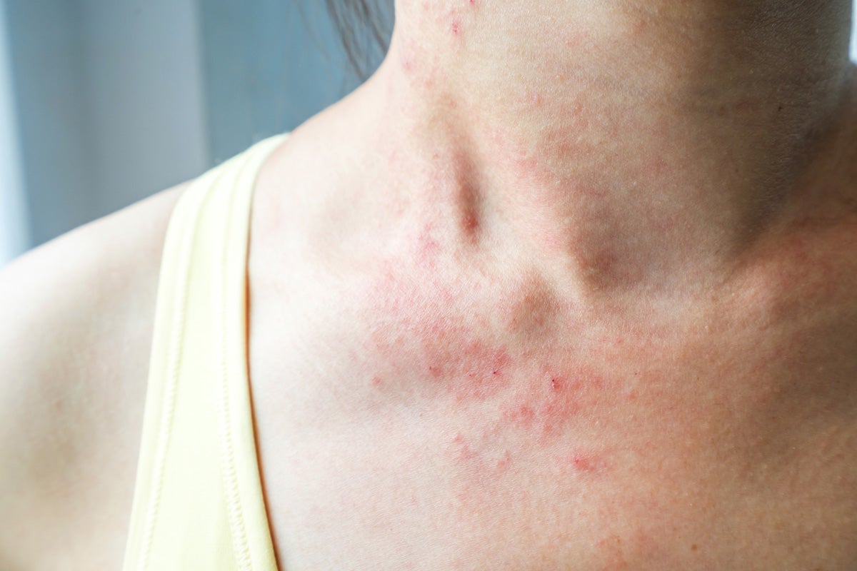 Histaminintoleranz: Typische Symptome, Ernährung & Tipps zur Behandlung
