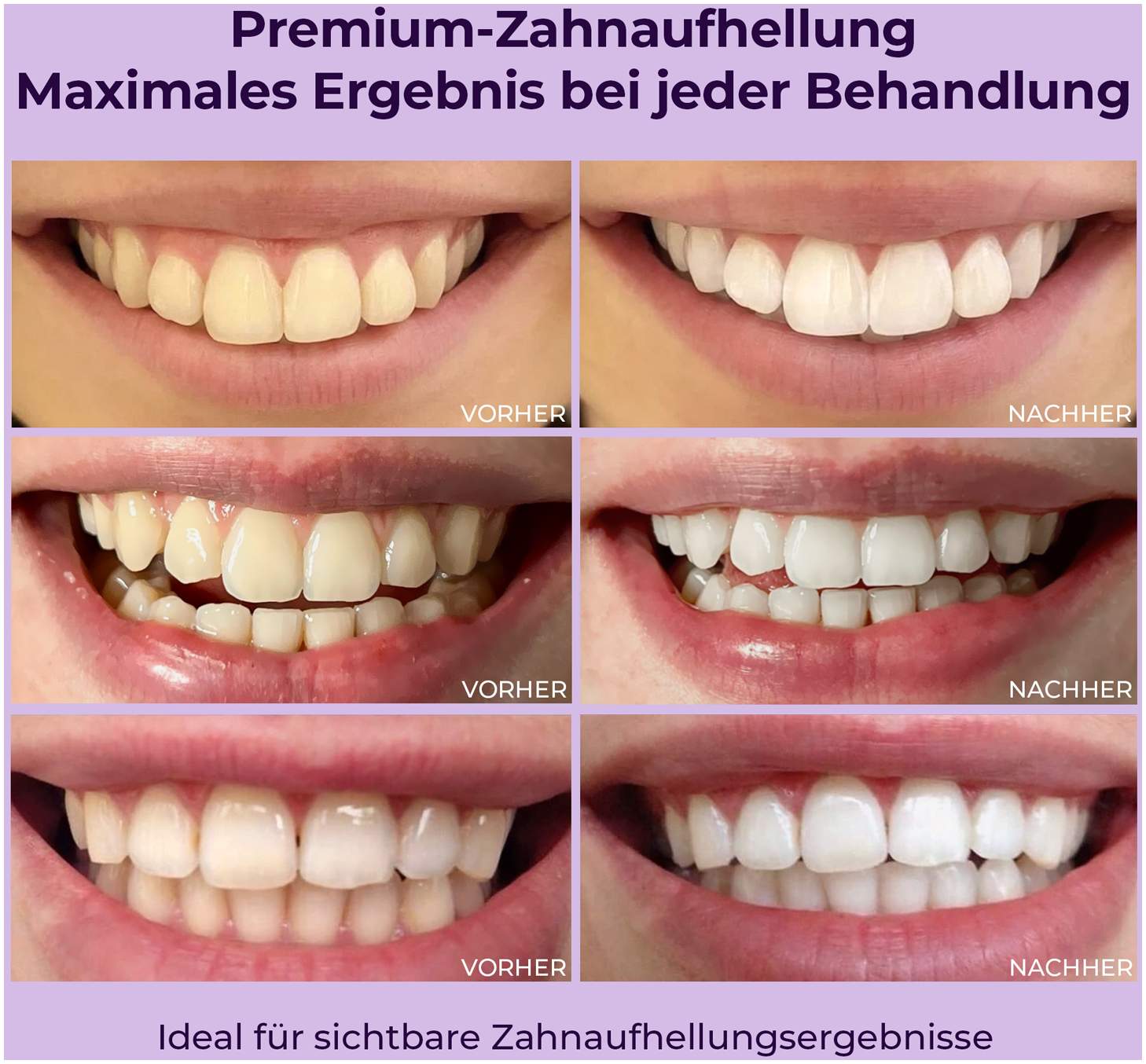 Onlysmile Zahnaufhellungsgel 3 X 40 ml