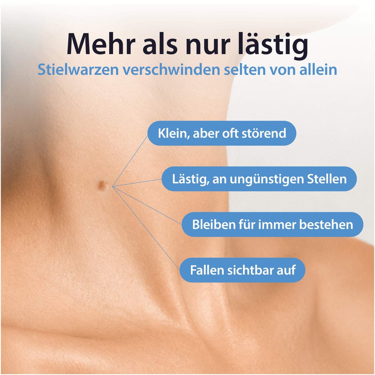 Acetocaustin Stielwarzen Entferner 50 ml Stift