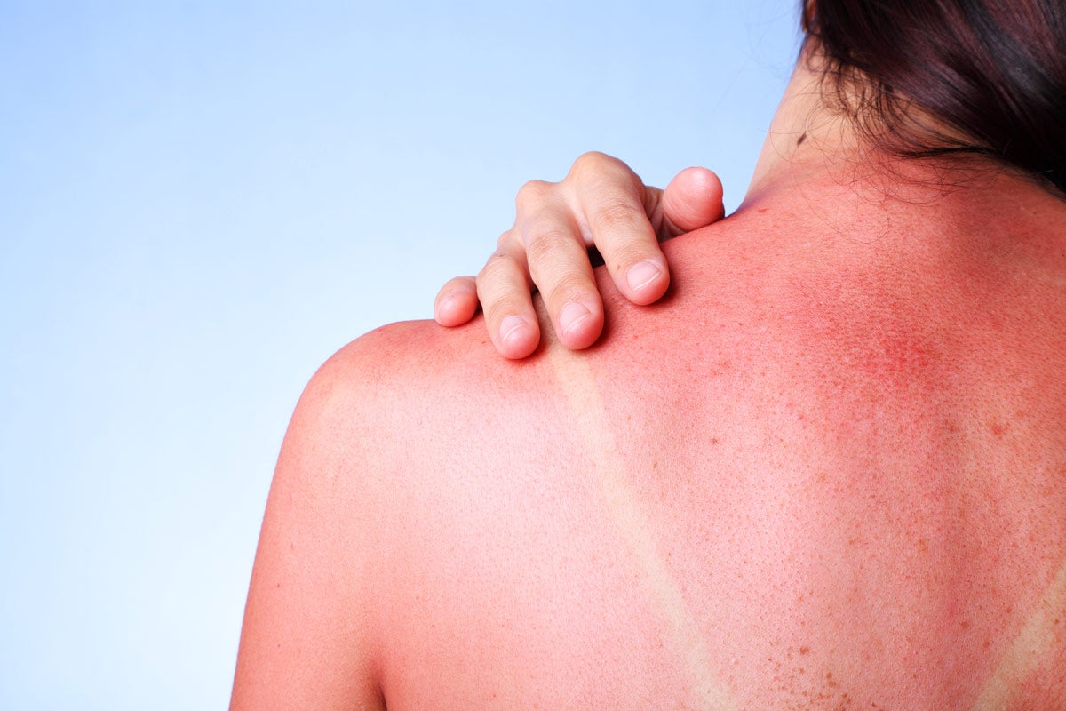 Sonnencreme bei Neurodermitis: Wichtige Tipps und Informationen