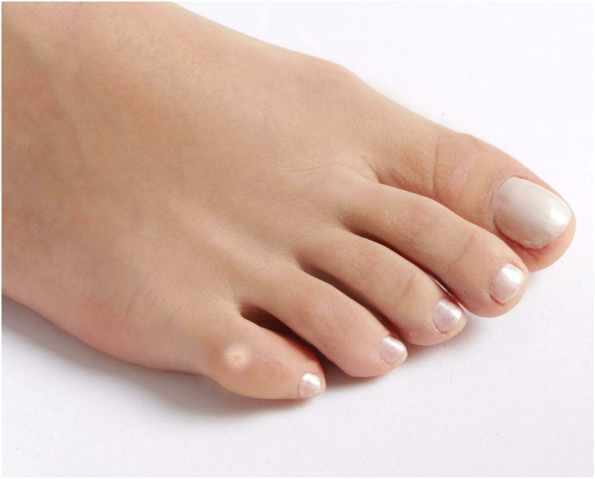 Vital Comfort Warzen-Tinktur 10 ml