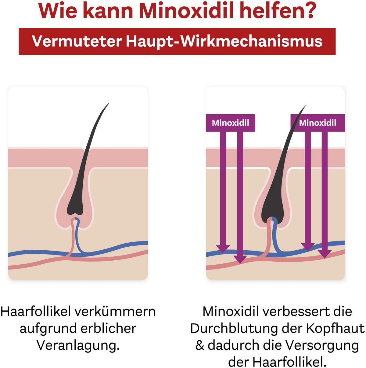Minoxidil Doppelherz Pharma 20 mg je ml 3 x 60 ml Lösung für Frauen