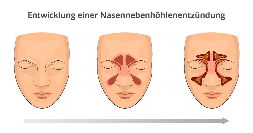 So entsteht eine Nasennebenhöhlenentzündung Entstehung und Verlauf einer Nasennebenhöhlenentzündung