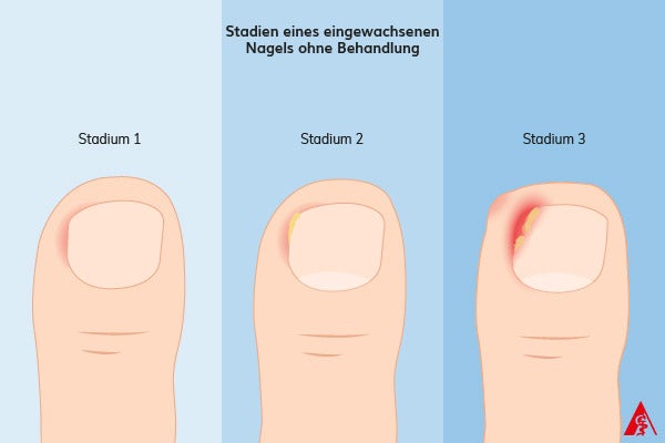 Stadien eines eingewachsenen Nagels ohne Behandlung Eine Illustration der drei Stadien bei einem eingewachsenen Nagel, sofern dieser nicht behandelt wird. Anfangs ist der Nagelfalz nur leicht gerötet und schmerzt, am Ende eitert die Stelle häufig und es bildet sich Granulationsgewebee.