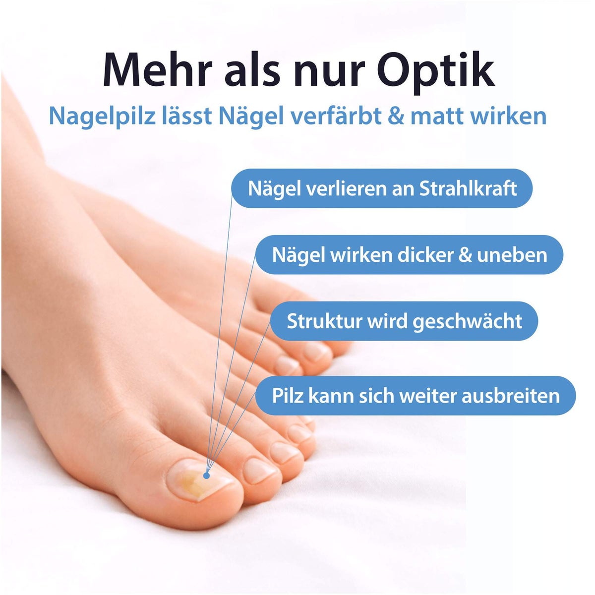 Acetocaustin Nagelpilz Lösung mit Aufhellung 9 ml