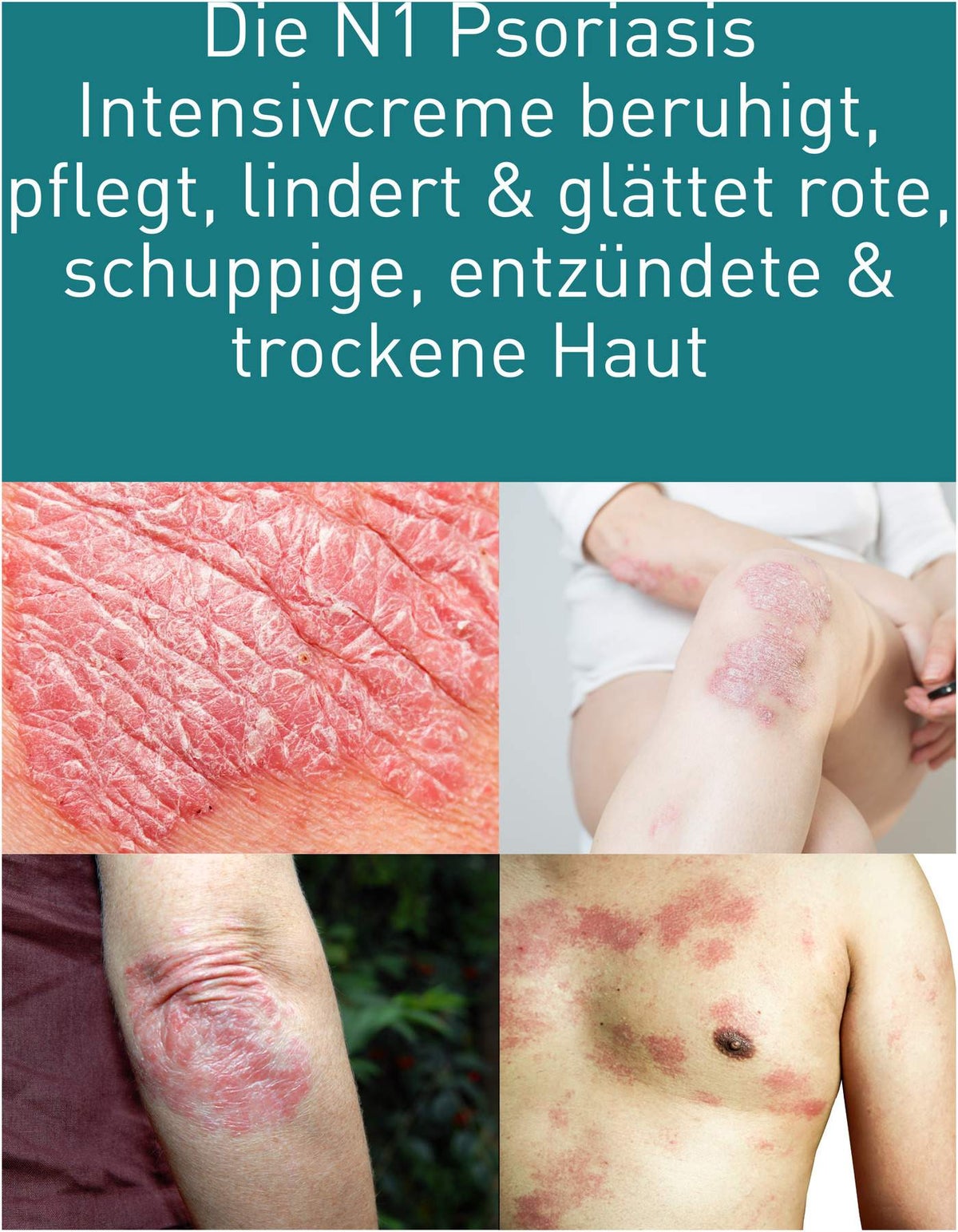 N1 Psoriasis Intensivcreme 50 ml