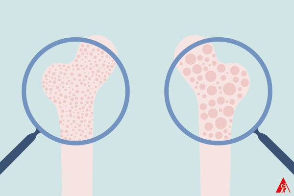 Osteoporose: Was tun bei Knochenschwund?