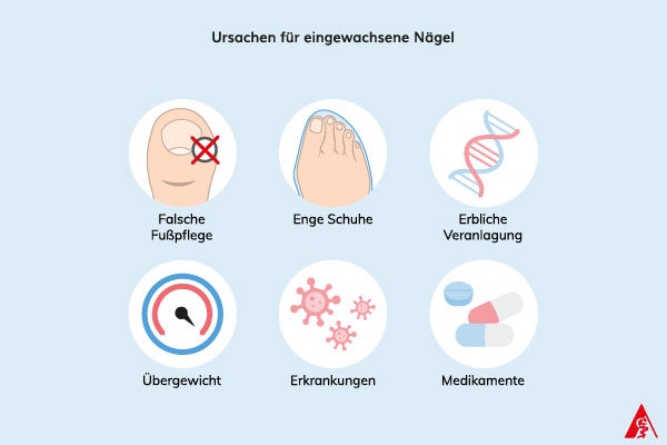 Ursachen für eingewachsene Nägel Eine Illustration von verschiedenen Ursachen für eingewachsene Nägel. Dazu gehören: Falsche Fußpflege, enge Schuhe, erbliche Veranlagerung, Übergewicht, bestimmte Erkrankungen sowie Medikamente.
