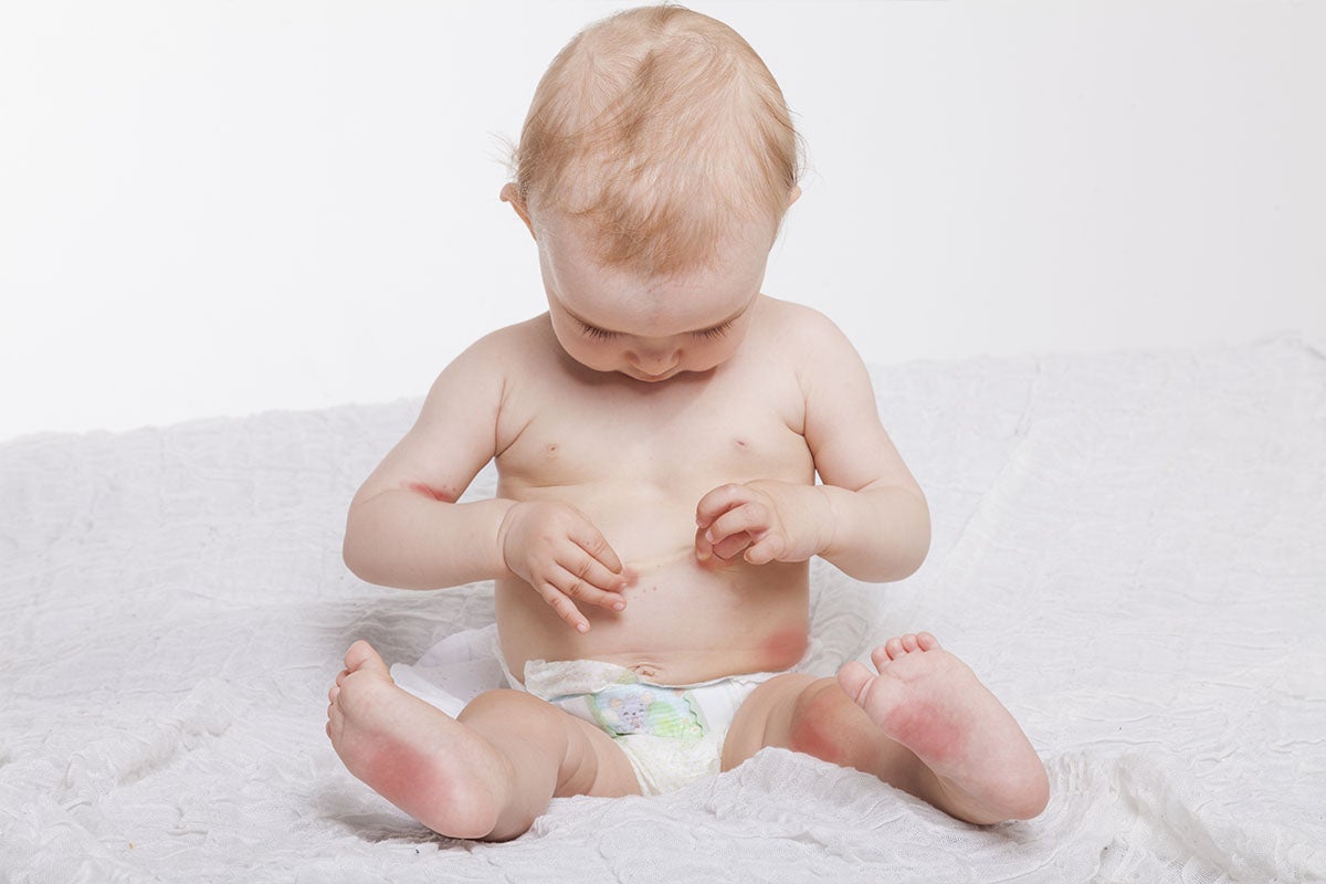 Neurodermitis bei Baby und Kind: Wissenswerte Informationen und Tipps
