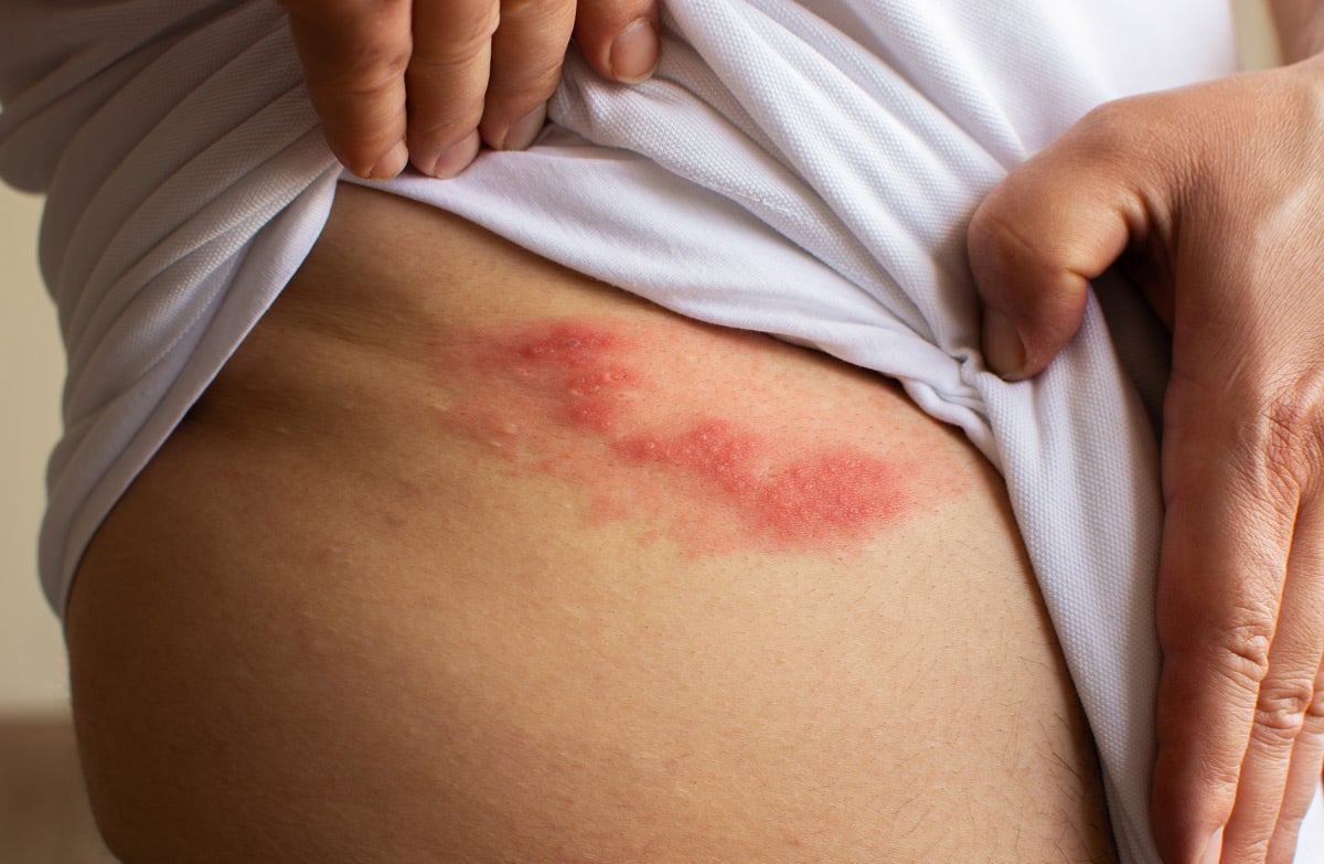 Gürtelrose behandeln: Schneller Therapiebeginn ist wichtig!