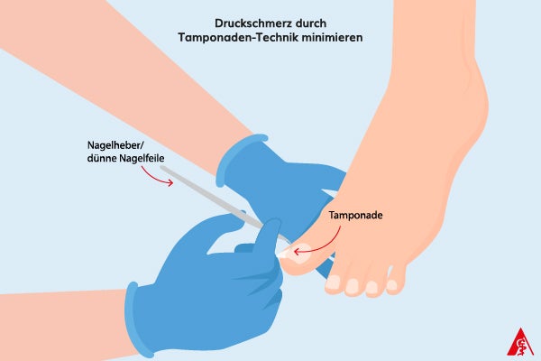 Druckschmerz bei eingewachsenem Nagel minimieren Eine Illustration wie man Druckschmerz bei einem eingewachsenen Nagel mithilfe einer Tamponade und einem Nagelheber bzw. einer dünnen Nagelfeile behebt.