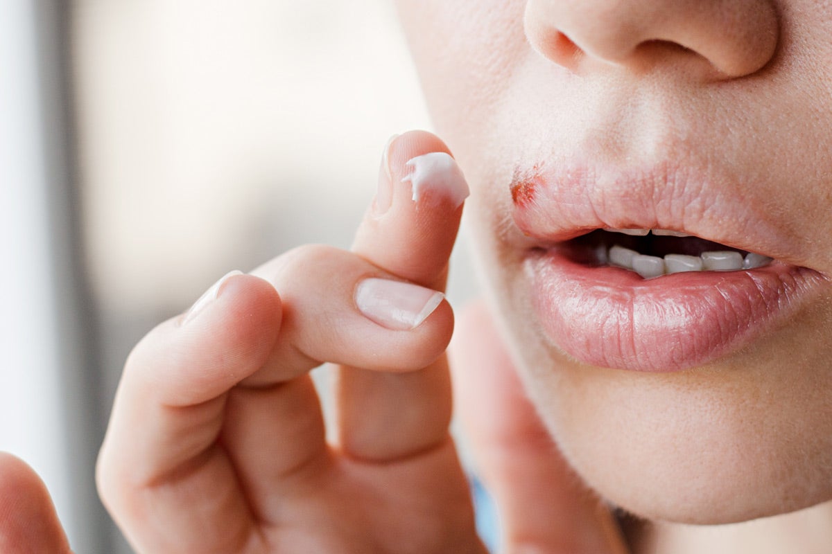 Lippenherpes und das Risiko einer Ansteckung
