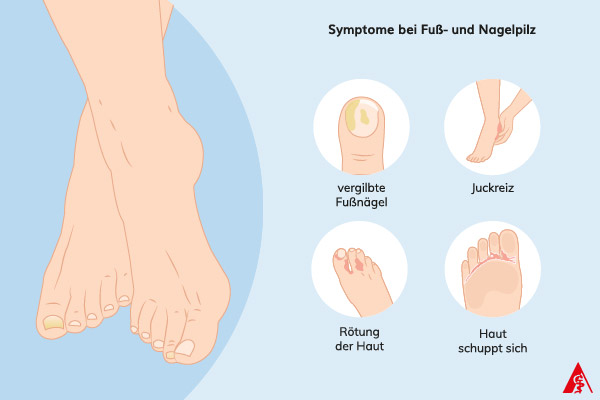 Eine Illustration der Symptome bei Fuß- und Nagelpilz. Dazu gehören vergilbte Nägel, juckende und schuppige Haut sowie Rötungen, vor allem an und zwischen den Zehen.