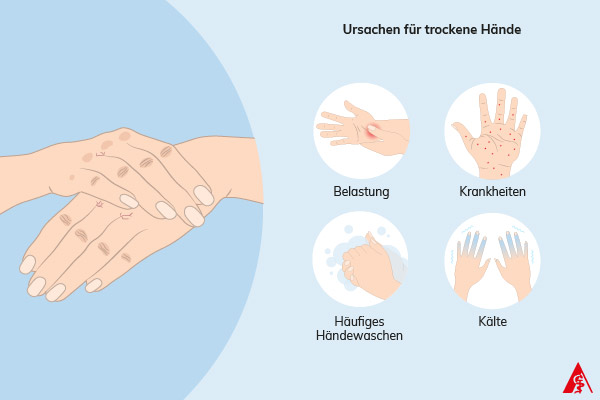 Eine Illustration der Ursache trockener Hände. Dazu gehören Belastung, Krankheiten, häufiges Händewaschen sowie Kälte.