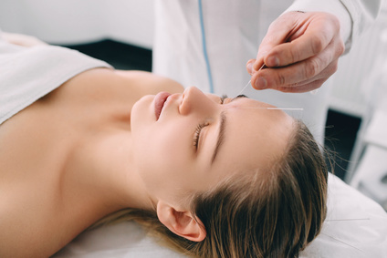 Frau bei einer Akupunktur-Behandlung