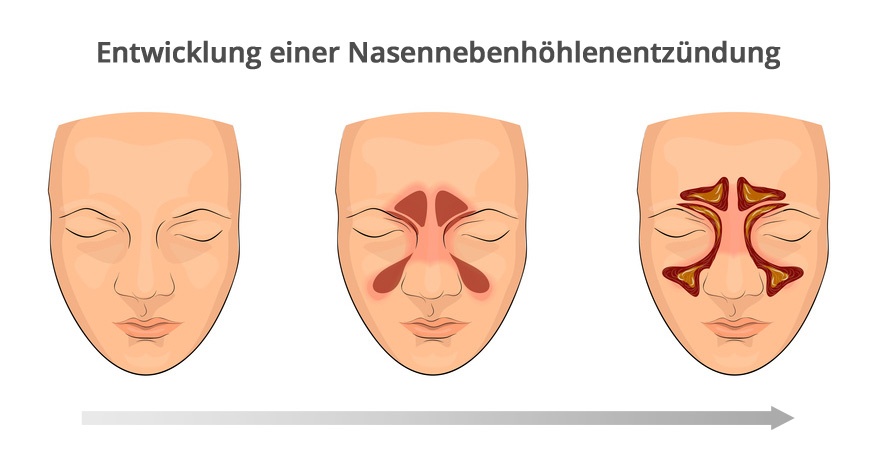 Entstehung und Verlauf einer Nasennebenhöhlenentzündung